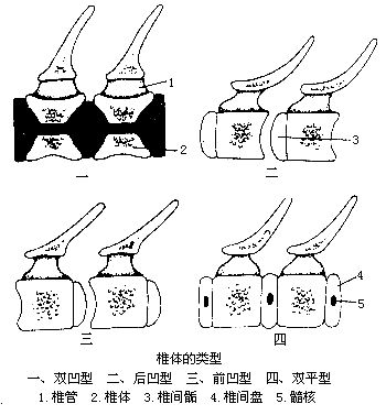 雙凹型椎體