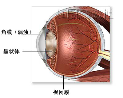 晶狀體過敏性色素膜炎