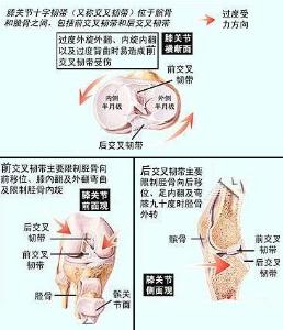 韌帶拉傷