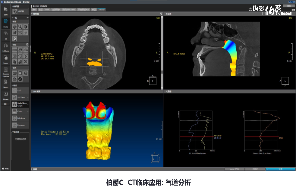 伯爵CBCT