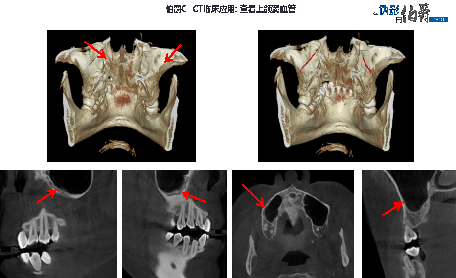 伯爵CBCT