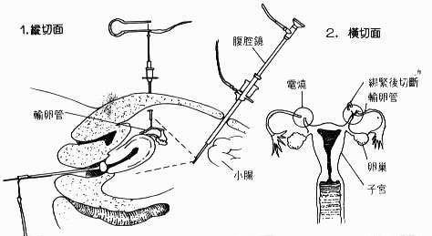 女性絕育手術示意圖