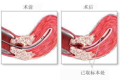 刮宮術