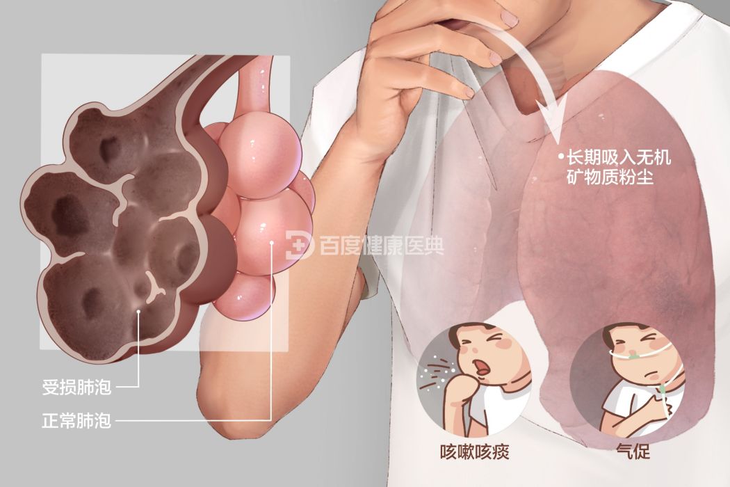 肺塵埃沉著病