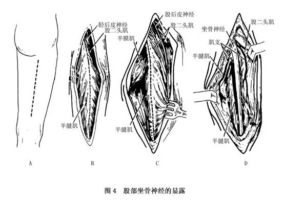 大腿以下或膝以下肌肉癱瘓