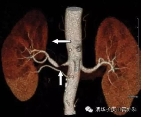 腎動脈狹窄性高血壓