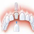 單顆種植牙齒