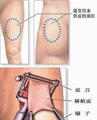 游離皮片移植