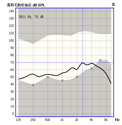 真耳未助聽回響