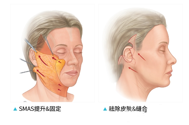 SMAS筋膜提升