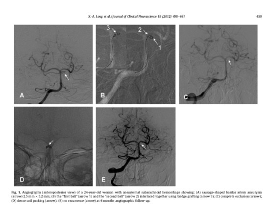 “交錯成籃技術”在顱內動脈瘤中的套用