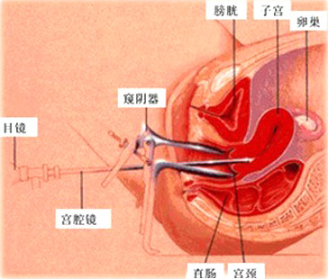 宮腔鏡可視取胚術