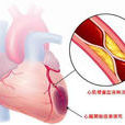 心肌梗塞護理