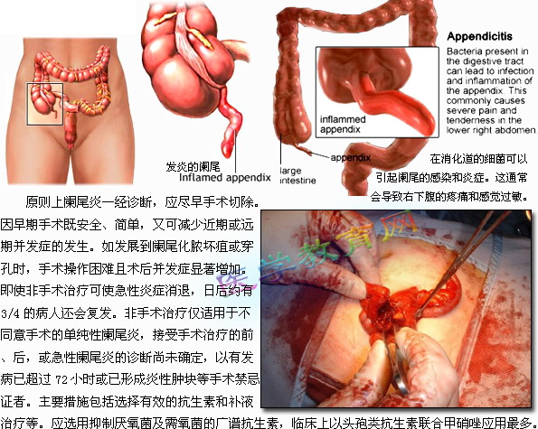 急慢性闌尾炎