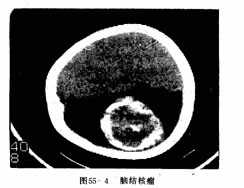 小腦幕腦膜瘤