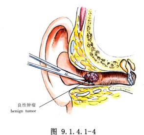 外耳道良性腫瘤切除術