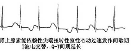 T波電交替