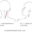 痙攣性斜頸的定向手術