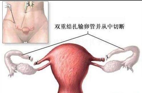 女性結紮手術