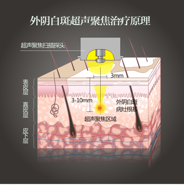 外陰白斑超聲聚焦治療原理