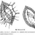 成人腹股溝斜疝