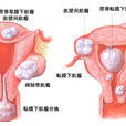 漿膜下子宮肌瘤