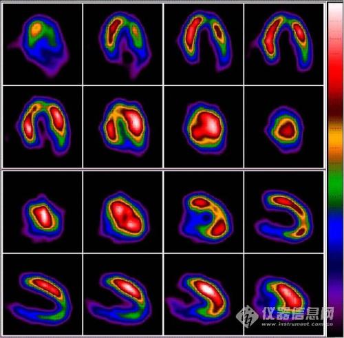 心肌血流灌注顯像(心肌血流灌注顯象)