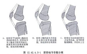 脛骨結節撕脫骨折切開復位術