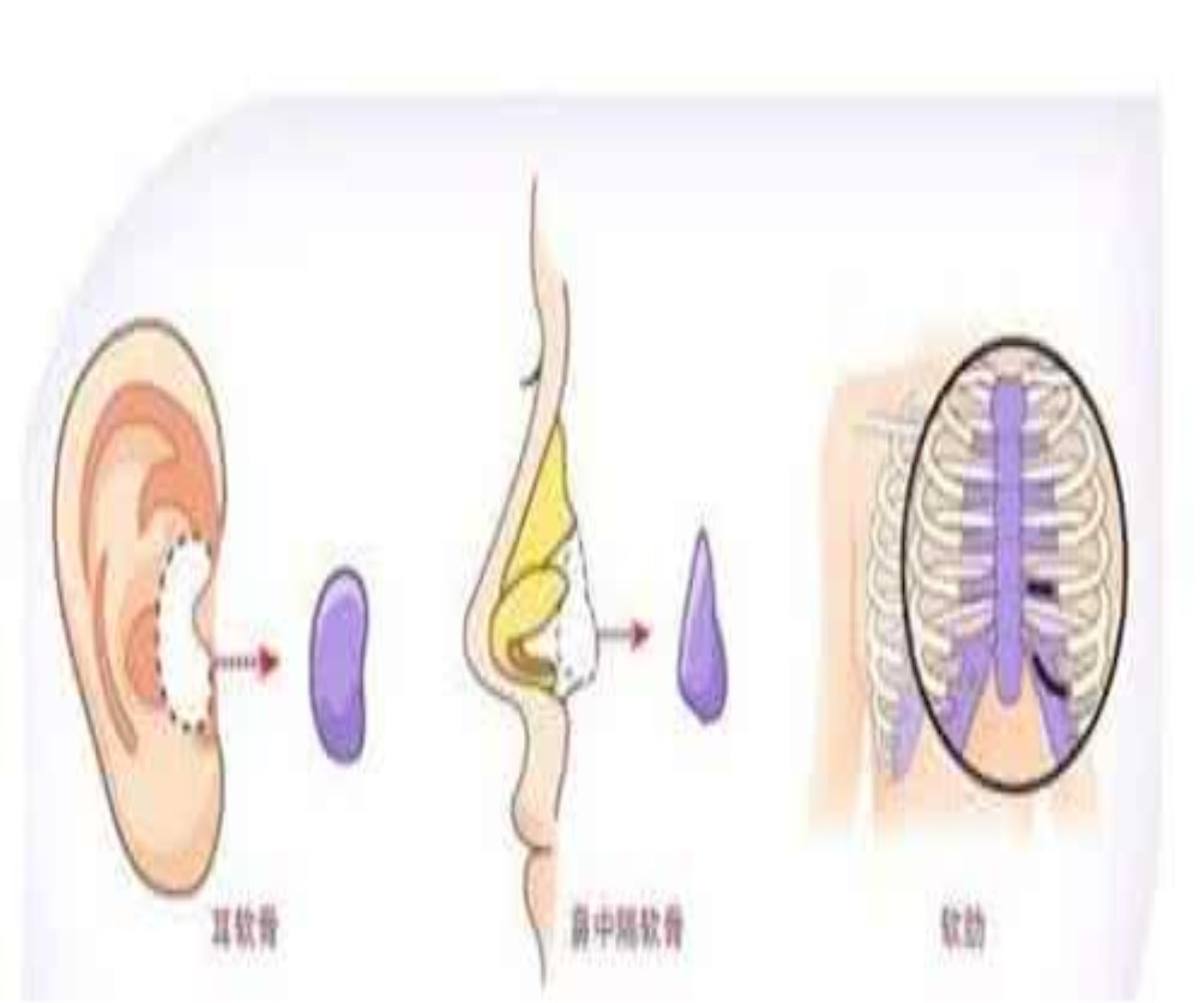 軟骨隆鼻