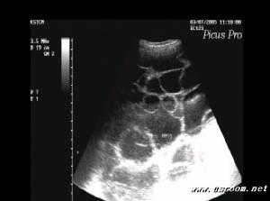 卵巢多發性囊腫