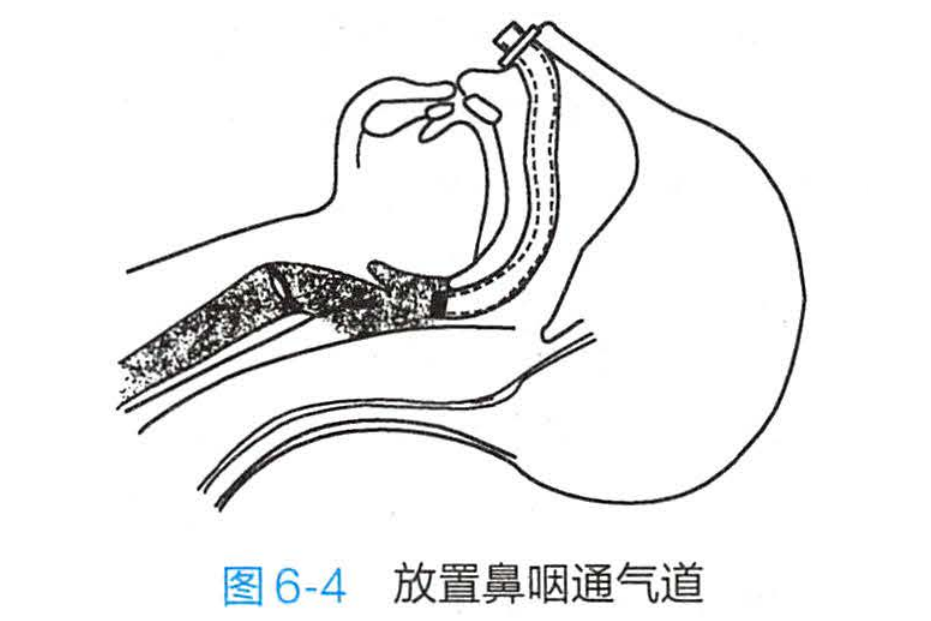 鼻咽通氣管