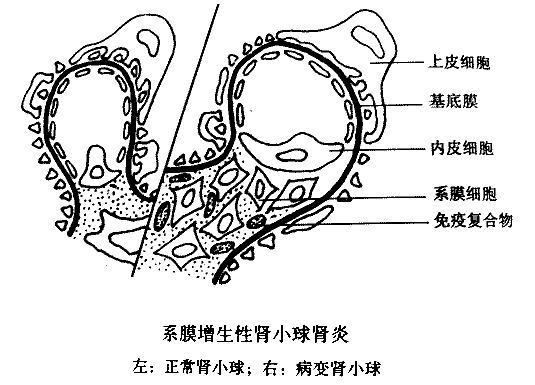 系膜毛細血管性腎小球腎炎