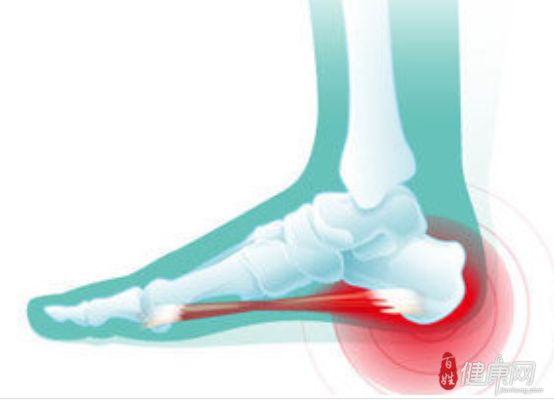 跟骨刺