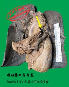 急性肺原性心臟病 病理