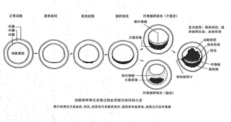 複合病變