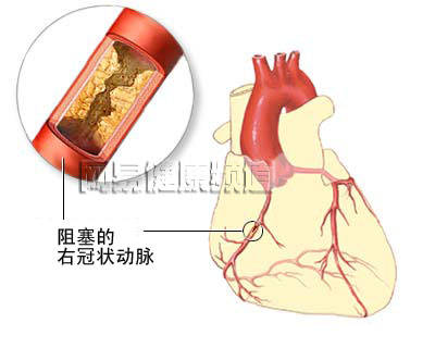 急性心KK死的診斷和治療