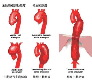 梅毒性主動脈瘤