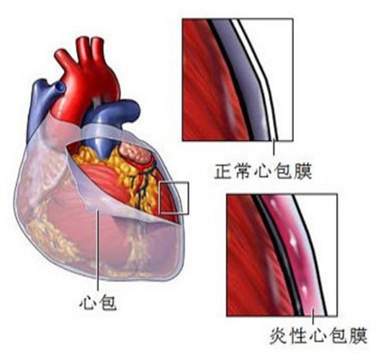 非特異性心包炎