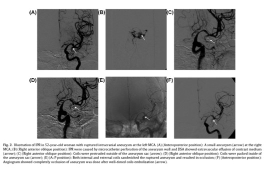 顱內動脈動脈瘤介入術中破裂的處理
