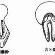 牙囊腫