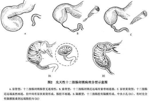 十二指腸閉鎖和狹窄