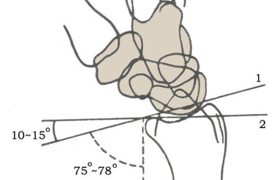 橈骨掌傾角