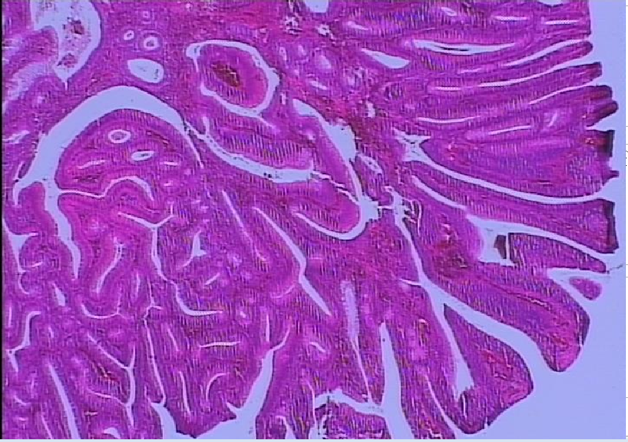 絨毛管狀腺瘤