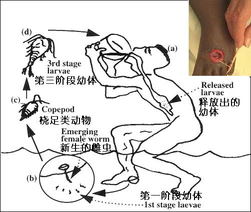 麥地那線蟲病病史