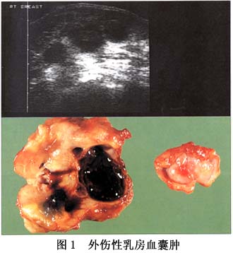 外傷性乳房血囊腫