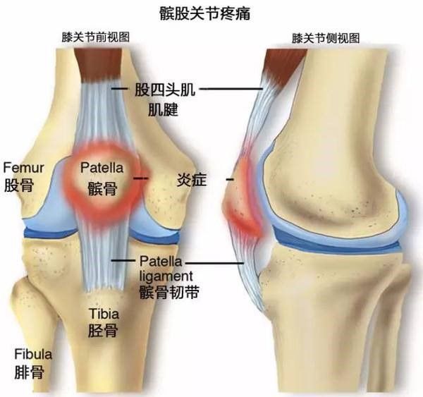 髕骨疼痛