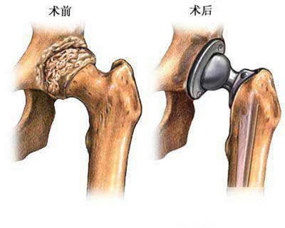 膝髖關節置換