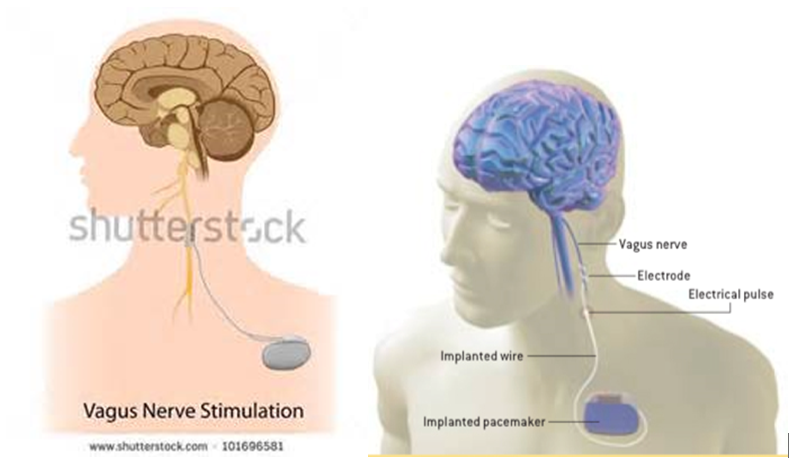 迷走神經刺激器