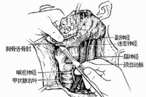 高碘性甲狀腺腫