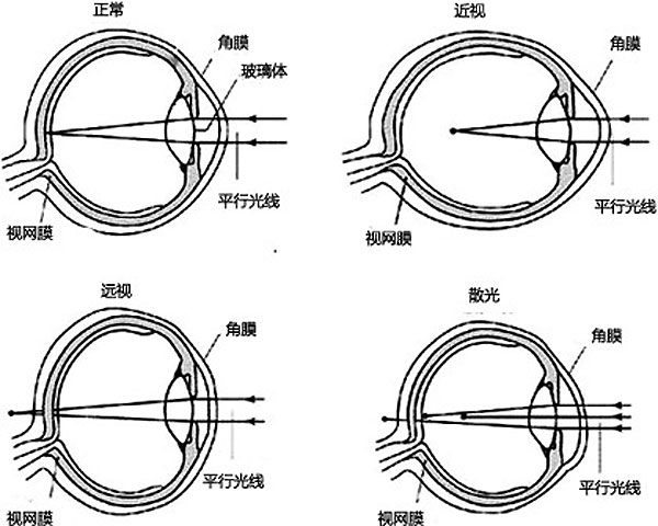 眼睛屈光